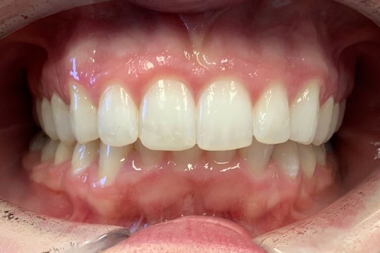 Composite Bonding in Southend, LeighonSea Leigh Dental Centre