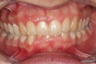 Enlighten teeth whitening essex