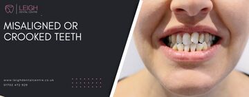 Misaligned or crooked teeth