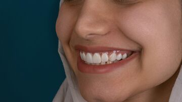 Invisalign Aftercare: Tips to Maintain Your New Smile in Essex
